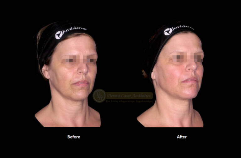 Derma Laser Aesthetics - Δρ. Σταματίνα Γελέκη | Υαλουρονικό οξύ