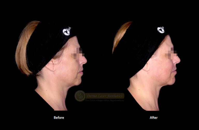 Derma Laser Aesthetics - Δρ. Σταματίνα Γελέκη | Υαλουρονικό οξύ