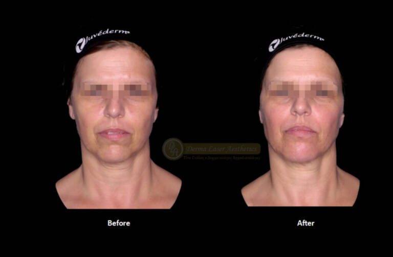 Derma Laser Aesthetics - Δρ. Σταματίνα Γελέκη | Υαλουρονικό οξύ
