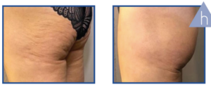Derma Laser Aesthetics - Δρ. Σταματίνα Γελέκη | PBSerum - Νέα εντυπωσιακή θεραπεία με τη δύναμη των ανασυνδυασμένων ενζύμων