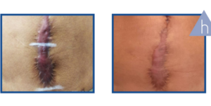 Derma Laser Aesthetics - Δρ. Σταματίνα Γελέκη | PBSerum - Νέα εντυπωσιακή θεραπεία με τη δύναμη των ανασυνδυασμένων ενζύμων