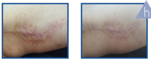 Derma Laser Aesthetics - Δρ. Σταματίνα Γελέκη | PBSerum - Νέα εντυπωσιακή θεραπεία με τη δύναμη των ανασυνδυασμένων ενζύμων