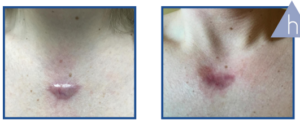 Derma Laser Aesthetics - Δρ. Σταματίνα Γελέκη | PBSerum - Νέα εντυπωσιακή θεραπεία με τη δύναμη των ανασυνδυασμένων ενζύμων