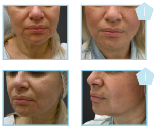Derma Laser Aesthetics - Δρ. Σταματίνα Γελέκη | PBSerum - Νέα εντυπωσιακή θεραπεία με τη δύναμη των ανασυνδυασμένων ενζύμων