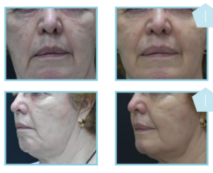 Derma Laser Aesthetics - Δρ. Σταματίνα Γελέκη | PBSerum - Νέα εντυπωσιακή θεραπεία με τη δύναμη των ανασυνδυασμένων ενζύμων