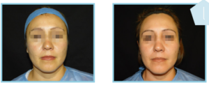 Derma Laser Aesthetics - Δρ. Σταματίνα Γελέκη | PBSerum - Νέα εντυπωσιακή θεραπεία με τη δύναμη των ανασυνδυασμένων ενζύμων