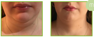 Derma Laser Aesthetics - Δρ. Σταματίνα Γελέκη | PBSerum - Νέα εντυπωσιακή θεραπεία με τη δύναμη των ανασυνδυασμένων ενζύμων