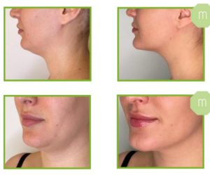 Derma Laser Aesthetics - Δρ. Σταματίνα Γελέκη | PBSerum - Νέα εντυπωσιακή θεραπεία με τη δύναμη των ανασυνδυασμένων ενζύμων