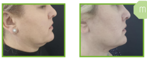 Derma Laser Aesthetics - Δρ. Σταματίνα Γελέκη | PBSerum - Νέα εντυπωσιακή θεραπεία με τη δύναμη των ανασυνδυασμένων ενζύμων