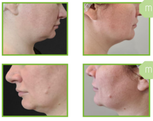 Derma Laser Aesthetics - Δρ. Σταματίνα Γελέκη | PBSerum - Νέα εντυπωσιακή θεραπεία με τη δύναμη των ανασυνδυασμένων ενζύμων