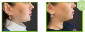 Derma Laser Aesthetics - Δρ. Σταματίνα Γελέκη | PBSerum - Νέα εντυπωσιακή θεραπεία με τη δύναμη των ανασυνδυασμένων ενζύμων