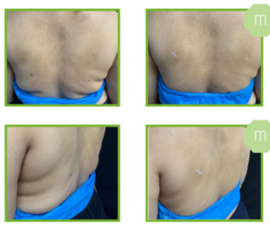 Derma Laser Aesthetics - Δρ. Σταματίνα Γελέκη | PBSerum - Νέα εντυπωσιακή θεραπεία με τη δύναμη των ανασυνδυασμένων ενζύμων