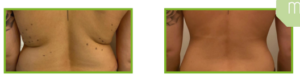Derma Laser Aesthetics - Δρ. Σταματίνα Γελέκη | PBSerum - Νέα εντυπωσιακή θεραπεία με τη δύναμη των ανασυνδυασμένων ενζύμων