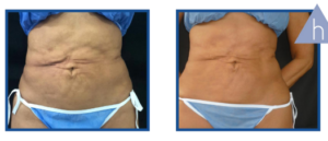 Derma Laser Aesthetics - Δρ. Σταματίνα Γελέκη | PBSerum - Νέα εντυπωσιακή θεραπεία με τη δύναμη των ανασυνδυασμένων ενζύμων