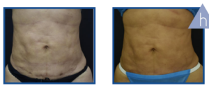 Derma Laser Aesthetics - Δρ. Σταματίνα Γελέκη | PBSerum - Νέα εντυπωσιακή θεραπεία με τη δύναμη των ανασυνδυασμένων ενζύμων