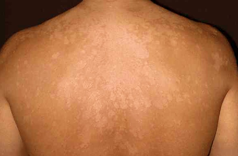 Derma Laser Aesthetics - Δρ. Σταματίνα Γελέκη | ΠΟΙΚΙΛΟΧΡΟΥΣ ΠΙΤΥΡΙΑΣΗ