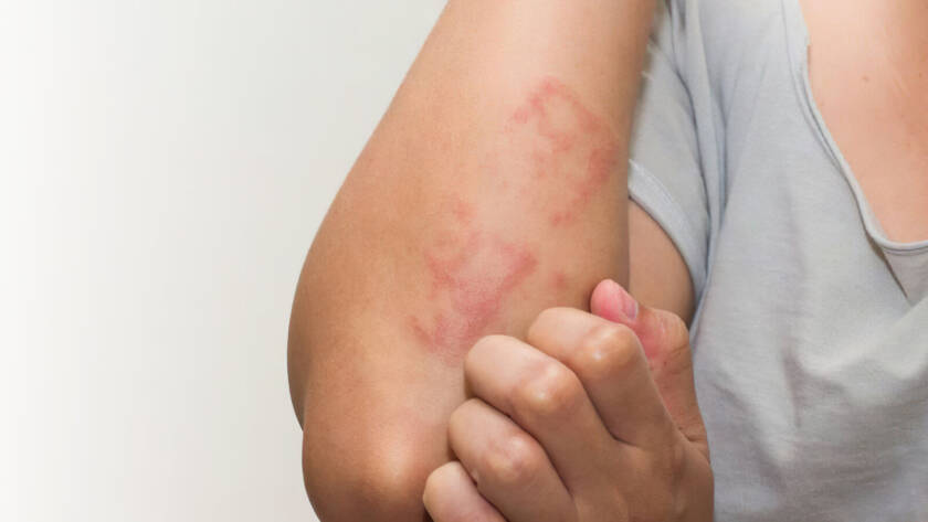 Derma Laser Aesthetics - Δρ. Σταματίνα Γελέκη | Ατοπική Δερματίτιδα