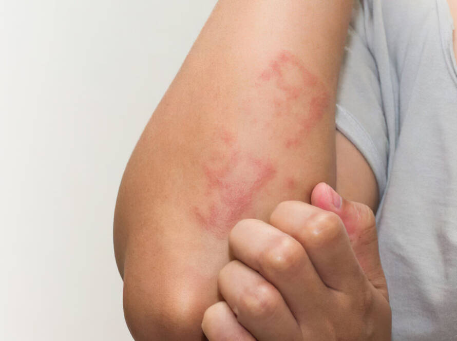 Derma Laser Aesthetics - Δρ. Σταματίνα Γελέκη | Ατοπική Δερματίτιδα