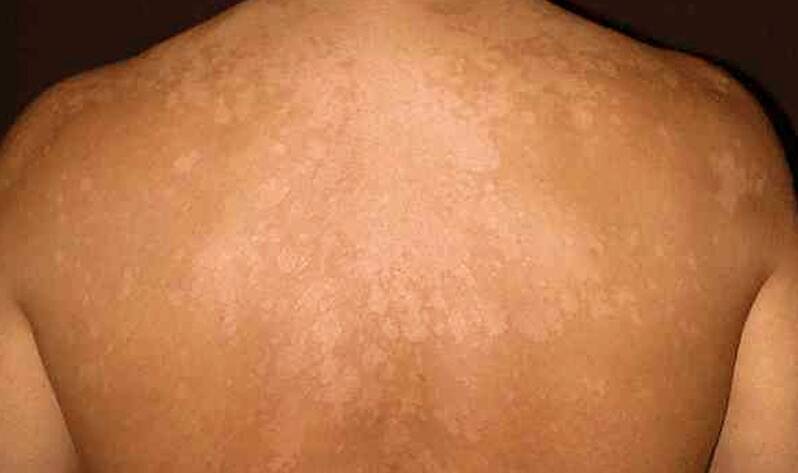 Derma Laser Aesthetics - Δρ. Σταματίνα Γελέκη | ΠΟΙΚΙΛΟΧΡΟΥΣ ΠΙΤΥΡΙΑΣΗ