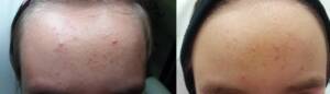 Derma Laser Aesthetics - Δρ. Σταματίνα Γελέκη | Ακμή