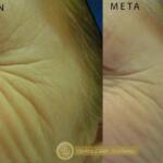 Derma Laser Aesthetics - Δρ. Σταματίνα Γελέκη | Botox