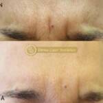 Derma Laser Aesthetics - Δρ. Σταματίνα Γελέκη | Botox