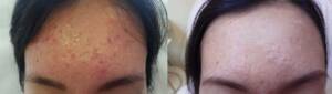 Derma Laser Aesthetics - Δρ. Σταματίνα Γελέκη | Ακμή