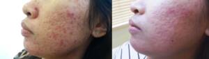 Derma Laser Aesthetics - Δρ. Σταματίνα Γελέκη | Ακμή