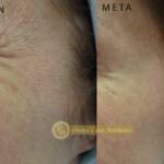 Derma Laser Aesthetics - Δρ. Σταματίνα Γελέκη | Botox