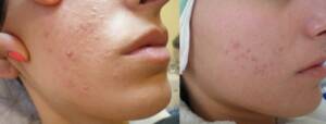 Derma Laser Aesthetics - Δρ. Σταματίνα Γελέκη | Ακμή