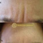 Derma Laser Aesthetics - Δρ. Σταματίνα Γελέκη | Botox