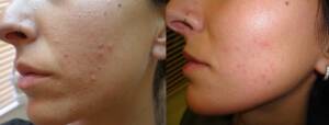 Derma Laser Aesthetics - Δρ. Σταματίνα Γελέκη | Ακμή