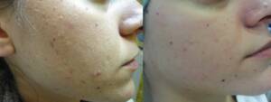 Derma Laser Aesthetics - Δρ. Σταματίνα Γελέκη | Ακμή