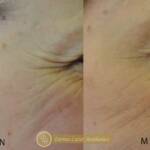 Derma Laser Aesthetics - Δρ. Σταματίνα Γελέκη | Botox